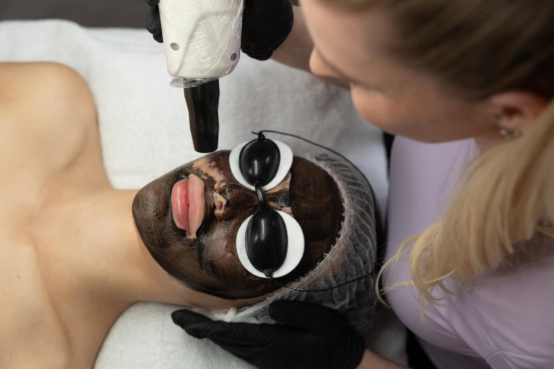 Laserové uhlíkové ošetrenie tváre (carbon peeling) v Estetickom štúdiu Spring — laserový násadec nad pleťou s uhlíkovou maskou a ochrannými okuliarmi.