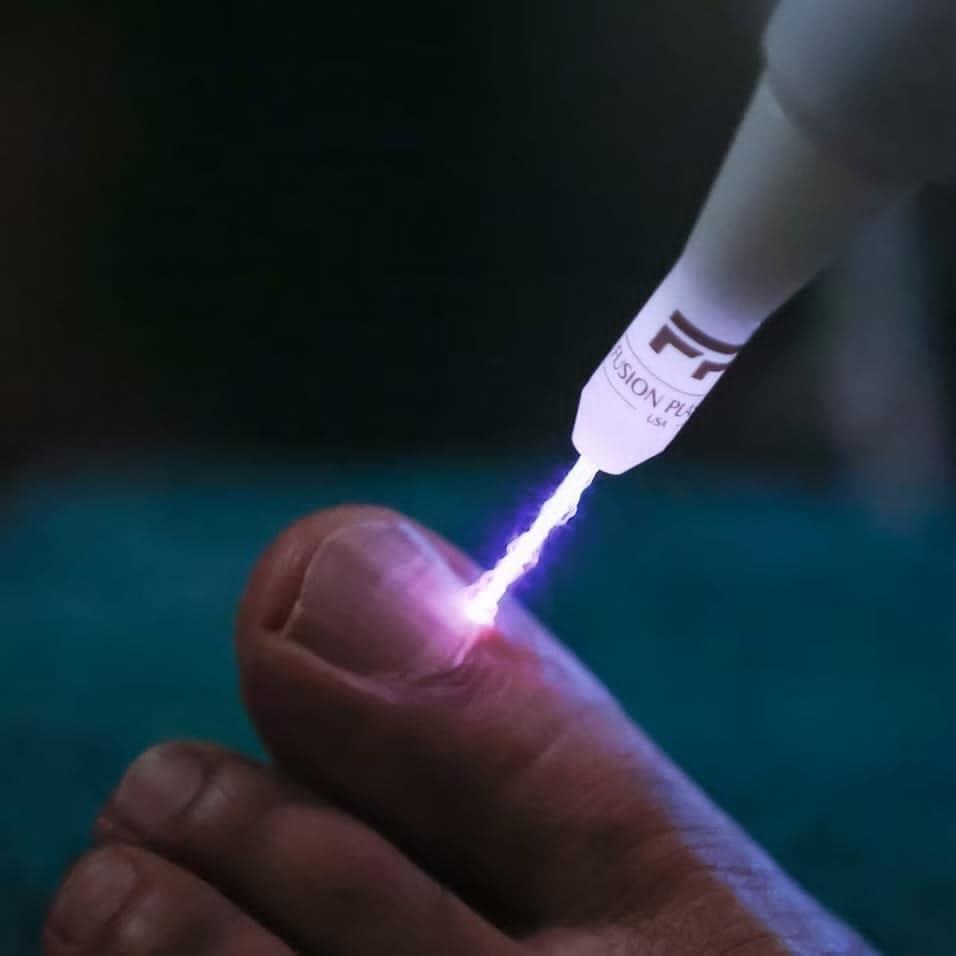 Ošetrenie nechta plazmovým výbojom Fusion Plasma.