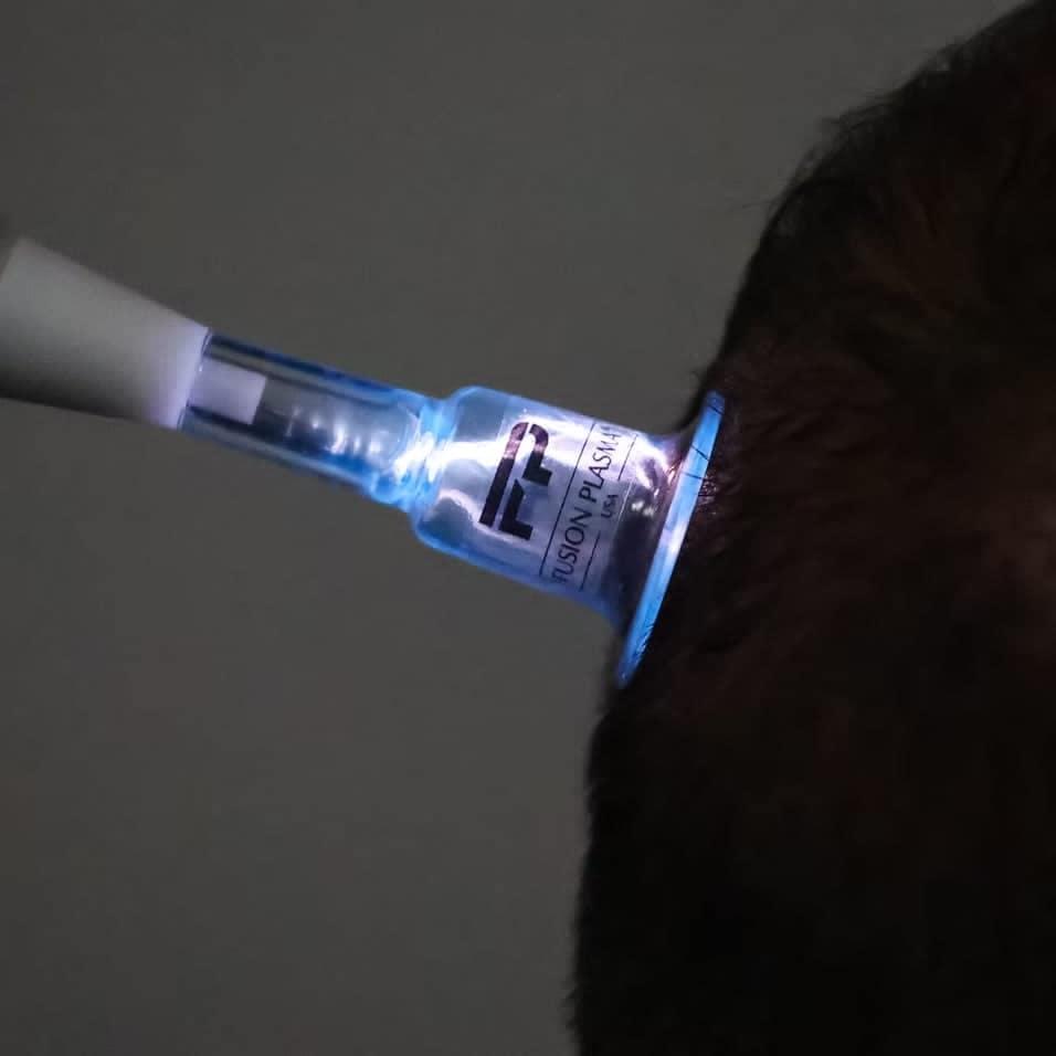 Ošetrenie vlasovej pokožky svietiacim násadcom Fusion Plasma.